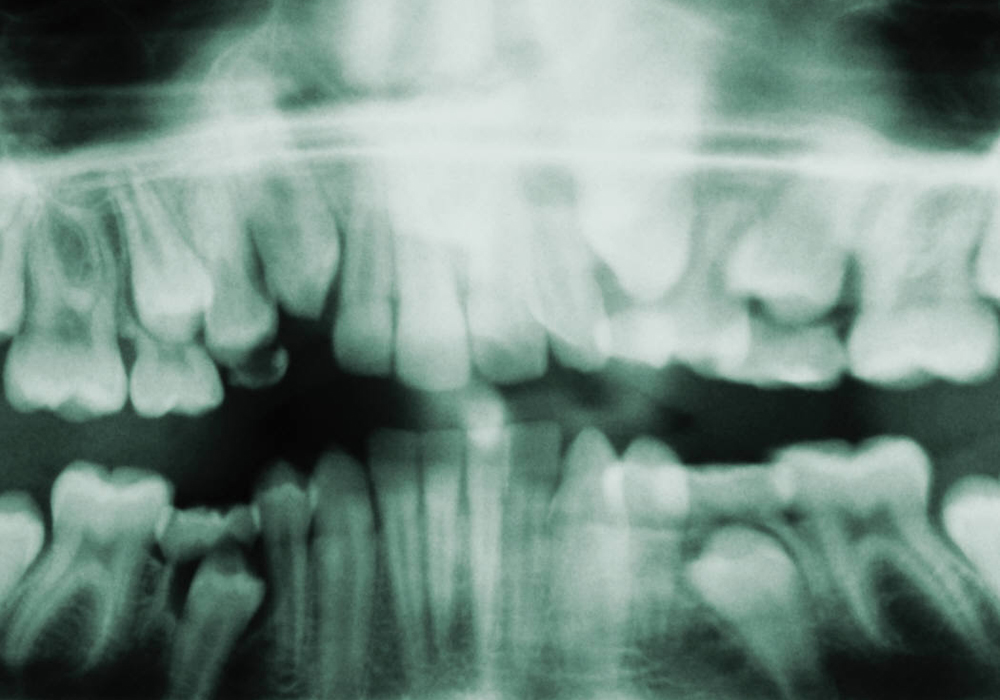 Full Mouth Panoramic X-Ray